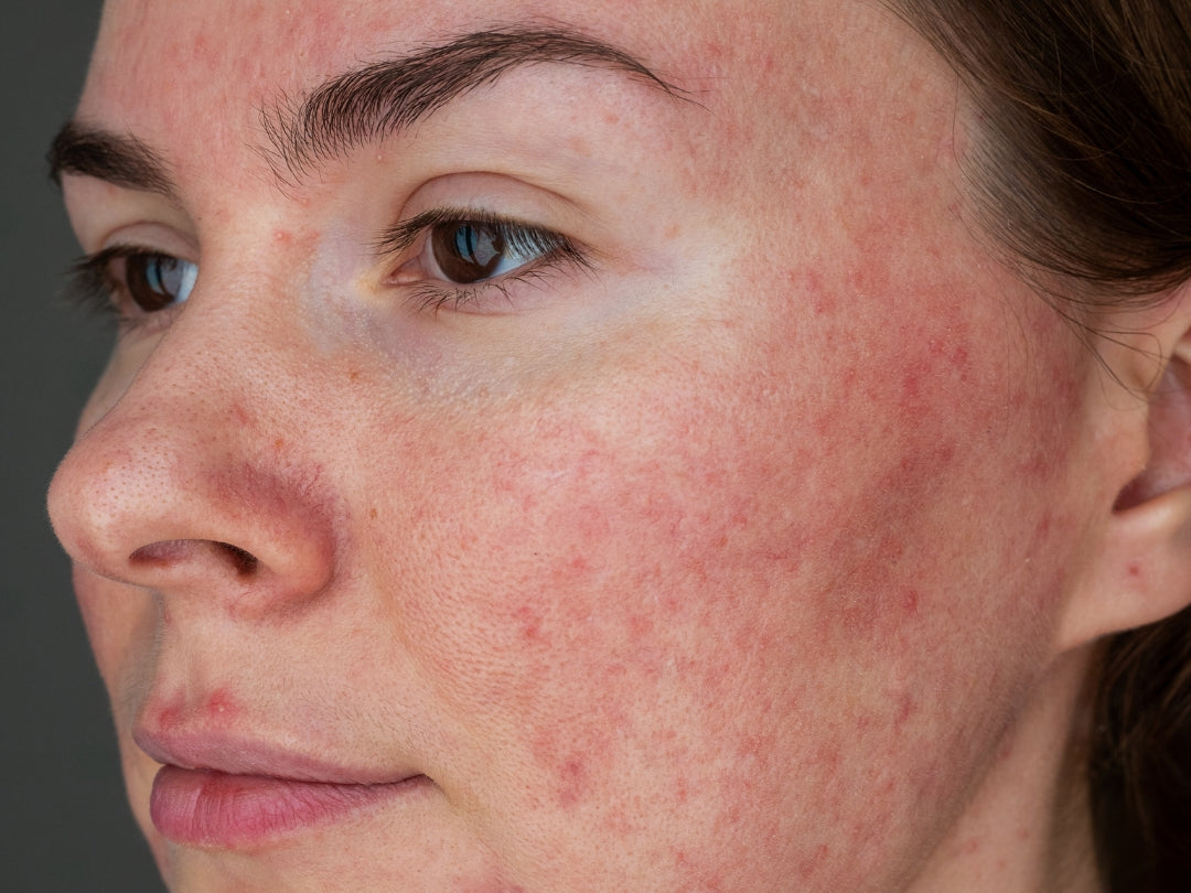 Rosacea erkennen und vorbeugen