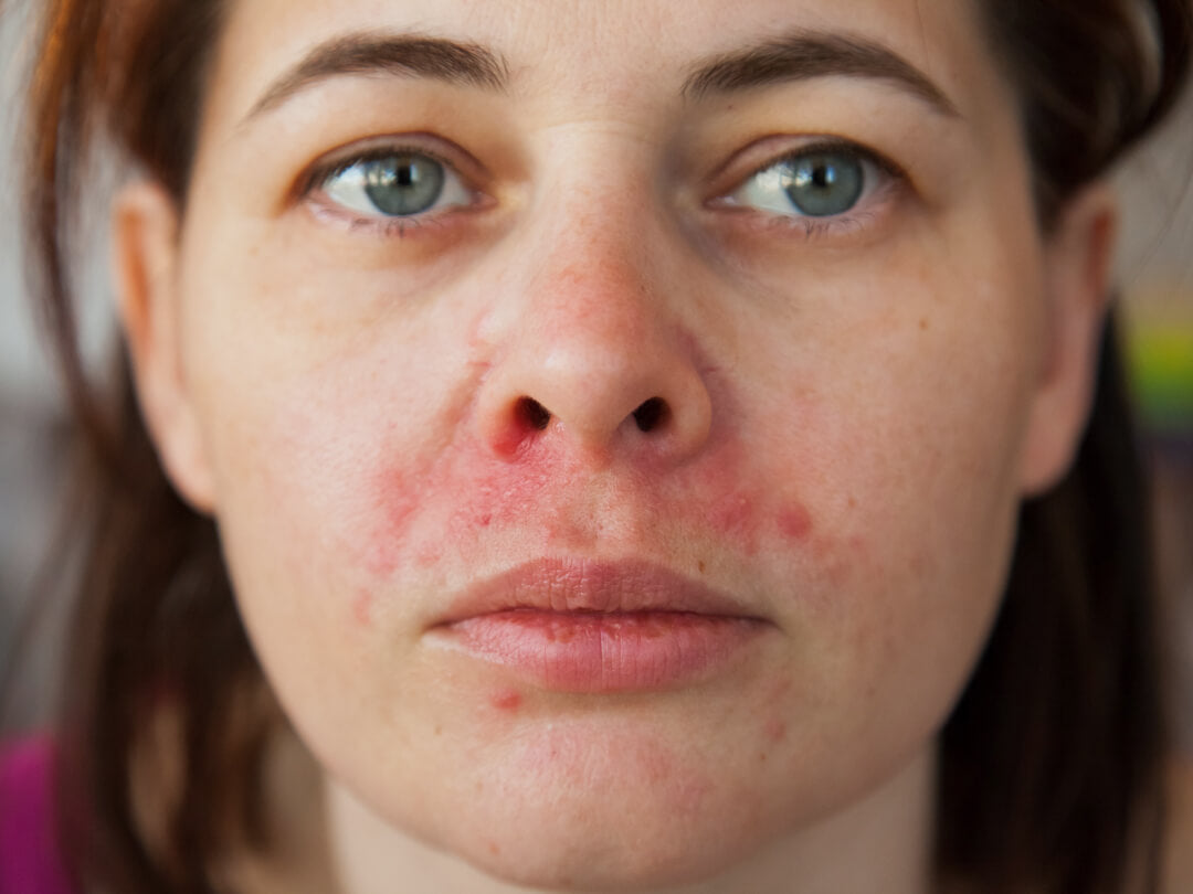 Gesicht einer Frau mit perioraler Dermatitis
